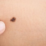 Πανελλαδικά δωρεάν εξετάσεις για καρκίνο του δέρματος από 9-13 Μαΐου