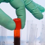 Νέο τεστ αίματος κάνει πιο γρήγορη διάγνωση του εμφράγματος