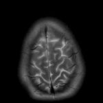 Υπό δοκιμή τα πρώτα εγκεφαλικά εμφυτεύματα με τεχνητή νοημοσύνη