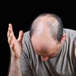 Μια νέα θεραπεία για τη φαλάκρα υπόσχεται ένα φάρμακο για… την οστεοπόρωση