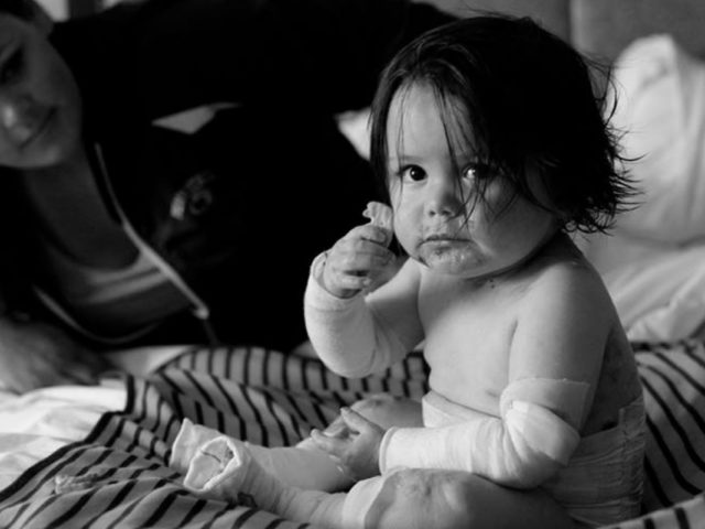 Τα παιδιά-πεταλούδες υποφέρουν από τη χειρότερη ασθένεια που ίσως να μην έχετε ακούσει ποτέ