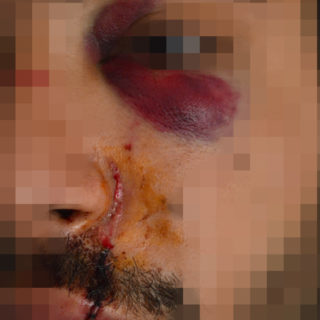 Φοιτητής καταγγέλλει πως τα ΜΑΤ τον άφησαν αναίσθητο, πεταμένο στα αίματά του [ΕΙΚΟΝΕΣ]