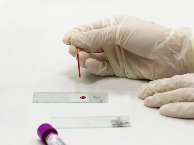Νέο τεστ αίματος προβλέπει τον κίνδυνο εμφράγματος και εγκεφαλικού με αυξημένη ακρίβεια