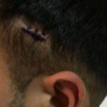 Ρατσιστική επίθεση στα Πατήσια: Οδηγός ταξί πυροβόλησε μετανάστη στο κεφάλι