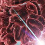 Οι παρεμβάσεις στη διάθεση μπορούν να μειώσουν τη φλεγμονή στη νόσο του Crohn και την ελκώδη κολίτιδα