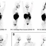 Οι ασθενείς με Long Covid μπορεί να εμφανίζουν σημάδια μη φυσιολογικής ενεργοποίησης των ανοσοποιητικών κυττάρων για χρόνια